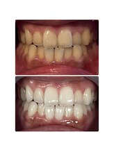 ホワイトニング ビューティー 南魚沼店(whitening beauty)/30代女性初めてのホワイトニング