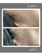 サイ(Sai)/もみあげ・頬周りスッキリ！