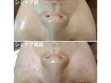 リノ(Lino)の雰囲気（【シミケア】痛みの少ない機械でシミケア￥3,980）