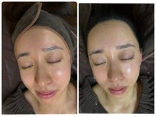 毛穴の汚れを取って、引き締めてあげるとこんなにも変わります♪