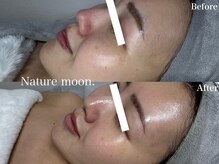 ナチュールムーン(Nature moon.)/ハーブピーリング