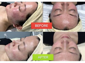 ファロンビューティー(fallon beauty)/国産ハーブピーリング