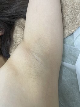 ナノハナ/鹿沼市の全身脱毛のナノハナ