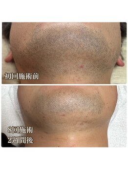 フェリス(FELIZ)/人気のヒゲ脱毛