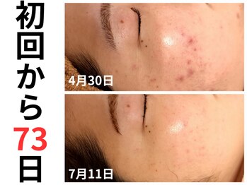 エリン(ERIN)/ハーブピーリング