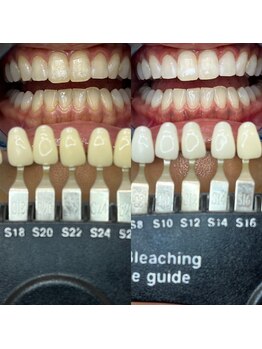 トウキョウスワーズ 池袋店(TOKYO SWRS)/#ホワイトニング #池袋 #渋谷