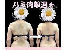 スワン 新栄店(SWAN)/ハミ肉撃退☆スッキリした背中へ