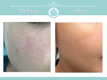 シミケアゼロ美人 表参道店(シミケアZERO美人)/【シミケア★シミゼロ症例】