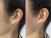 アールビューティー(R Beauty)/もみあげ脱毛で横顔美人に♪