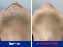 ミスターアンクール 鹿児島(Mr.uncoeur)/ヒゲ脱毛6回後