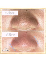 ウィズリリナ 新横浜(with Lilina.)/1回/毛穴洗浄/ハイドラ/新横浜