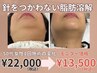 【本気の小顔ケアモニター】針を使わない脂肪分解PL+ラジオ波60分 ¥22,000→