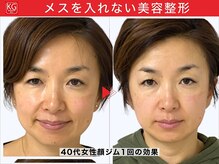 那賀洋子式 顔ジム 大分戸次店/AC40代女性顔ジム1回の効果
