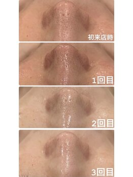 心斎橋 ルヴィ(REVI)の写真/「肌キレイになった?」その一言が、自信になる。毛穴の目立ちにくい、透明感あふれる素肌へ。