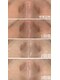 心斎橋 ルヴィ(REVI)の写真/「肌キレイになった?」その一言が、自信になる。毛穴の目立ちにくい、透明感あふれる素肌へ。