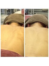 ブリリアント(Brilliant)/背中ケア