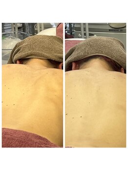 ブリリアント(Brilliant)/背中ケア