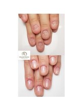 リメイクルーム 天王寺店(REMAKE ROOM)/深爪矯正Before→After