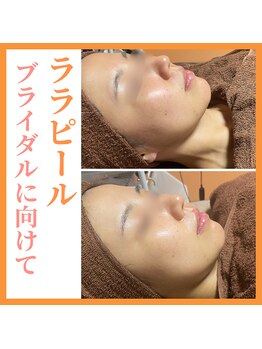 トータルビューティーサロン ヴィヴィエ(ViVier)/ララピール症例2回