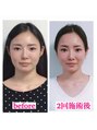 オリノ(Olino)&nbsp;面長の中顔面部分を短くして、バランスとらせていただきます。