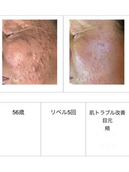 SDルーム/リベルハーブピーリング