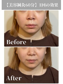 サンクエール 代官山鍼灸院(CINQ AILES)/美容鍼灸　小顔・浮腫み改善