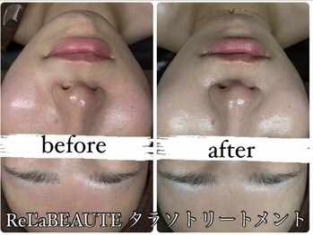 ビノスビューティー(vinos.beauty)/ReLABEAUTEタラソトリートメント