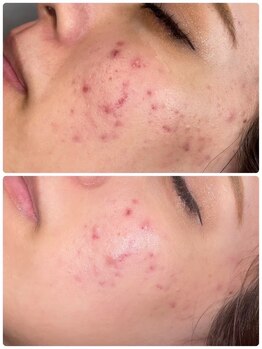 ホワイトニングビューティー 金沢駅前店(WHITENING BEAUTY)/お悩み別高機能美容液使用★