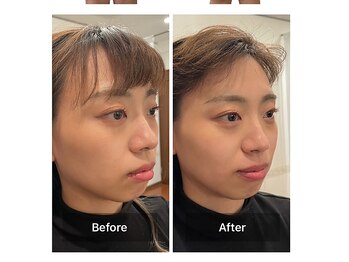 ベンザイ 梅田店(BENZAI)/顔のむくみ、リフトアップ