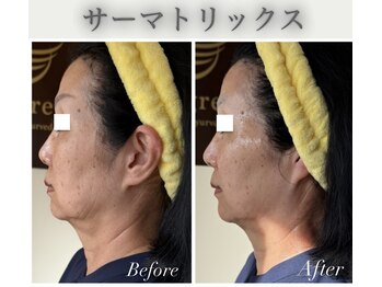 エバーグリーン(Evergreen)/たるみシワ改善×美容液導入