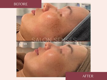 センシズ(Senses)/くすみ・シミ改善