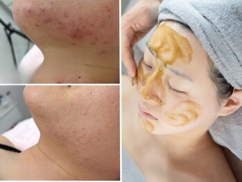 エルフ(elf)の写真/ニキビの改善に♪【ハーブピーリング＋毛穴洗浄★¥8800】ザラツキ・赤み解消！ニキビ前の赤ちゃん肌へ