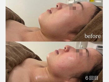 サロンワイアネシス(Salon y ANESIS)/小顔コルギ６回の変化