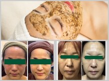 シャイニー(SHINY)の雰囲気（剥離なし／国産ハーブピーリング）