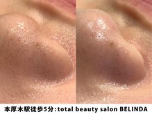 ベリンダ(BELINDA)/毛穴洗浄ハイドロスプラッシュ