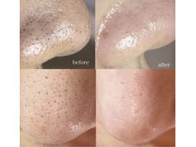 リリースブロウ(Release Brow)/角栓除去　黒ずみ　毛穴ケア