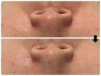 エフェクト 塚口店(effect)/Before After 40代/1回目