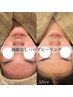 【美白/毛穴レスパウダー付き★】REVI陶肌ハーブピーリングお試し￥11,000