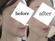 ケトリーナの雰囲気（最新の溶ける糸でリフトアップ☆ダウンタイムなしでハリ弾力UP♪）