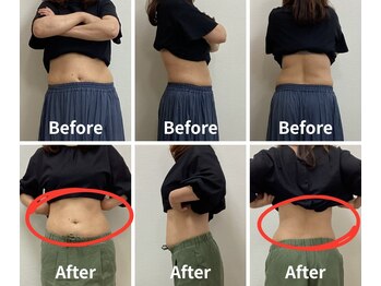 Noa接骨院 はりきゅう院/脂肪冷却 B/A写真