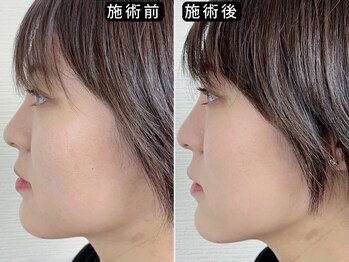 アオヤマ サロン ワイゼット(AOYAMA SALON YZ)/自信がもてるフェイスラインへ