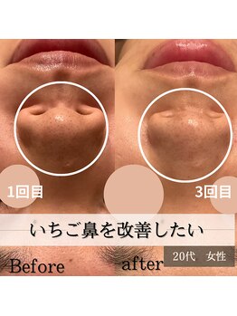 パルティノ 高崎店/小鼻の黒ずみが気になってマスク