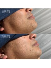 カナウ(KANAU)/ヒゲ脱毛（40代前半男性）