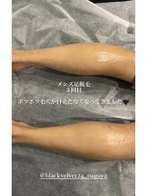 ブラックベルベット 24(BLACK VELVET 24)/名古屋メンズ脱毛★