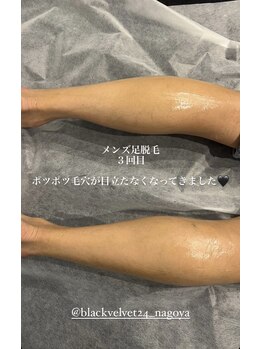 ブラックベルベット 24(BLACK VELVET 24)/名古屋メンズ脱毛★