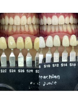 トウキョウスワーズ 池袋店(TOKYO SWRS)/#ホワイトニング #池袋 #渋谷