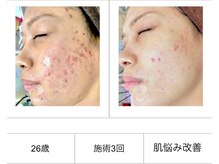 SDルーム/リベルハーブピーリング