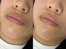 アールビューティー(R Beauty)/マスク外す準備できていますか？