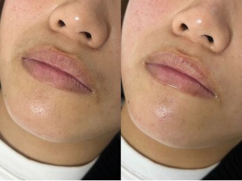 アールビューティー(R Beauty)/マスク外す準備できていますか？