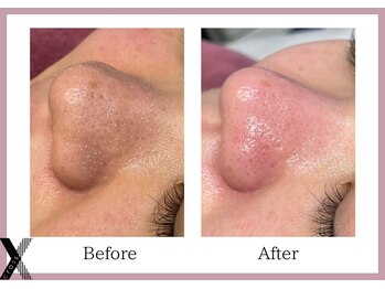 クロス(Xcross)/ハーブピーリング【毛穴/渋谷】